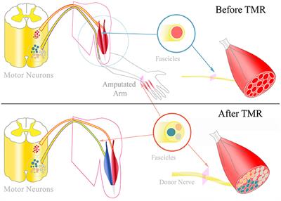 Broadband Prosthetic Interfaces: Combining Nerve Transfers and Implantable Multichannel EMG Technology to Decode Spinal Motor Neuron Activity